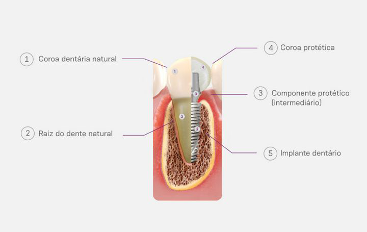 IMPLANTES DENTÁRIOS